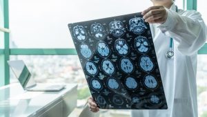 economic damages brain injury
