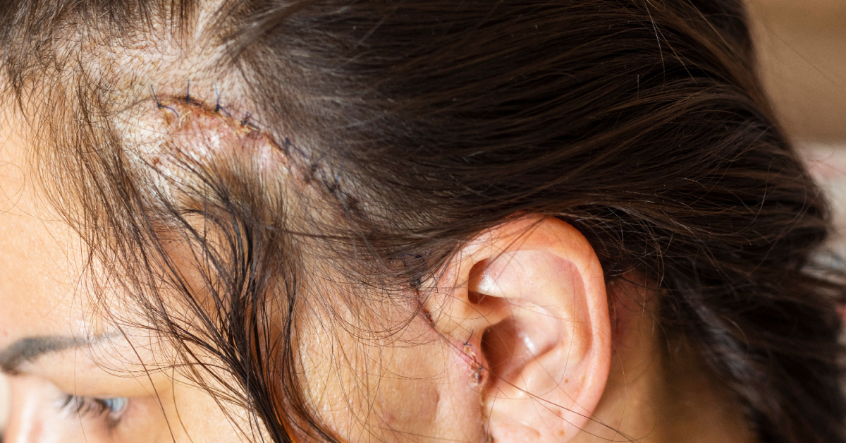 woman with severe face scar after major injury